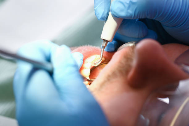 Best Emergency Root Canal Treatment in Plainville, KS